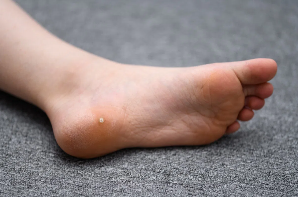 Plantar Wart Foot Removal Best Plantar Wart Surgery Removal 2021